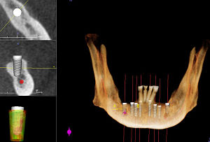 English: CT Scan for Dental Implants. This sho...