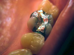 English: Mercury filling on first molar, shown...