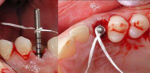 English: Straumann implant guide pin in place ...