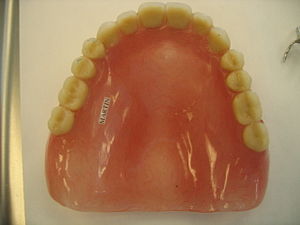 English: Occlusal of complete denture, example.