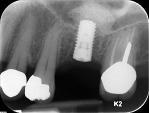 English: Straumann implant placed in site #14 ...